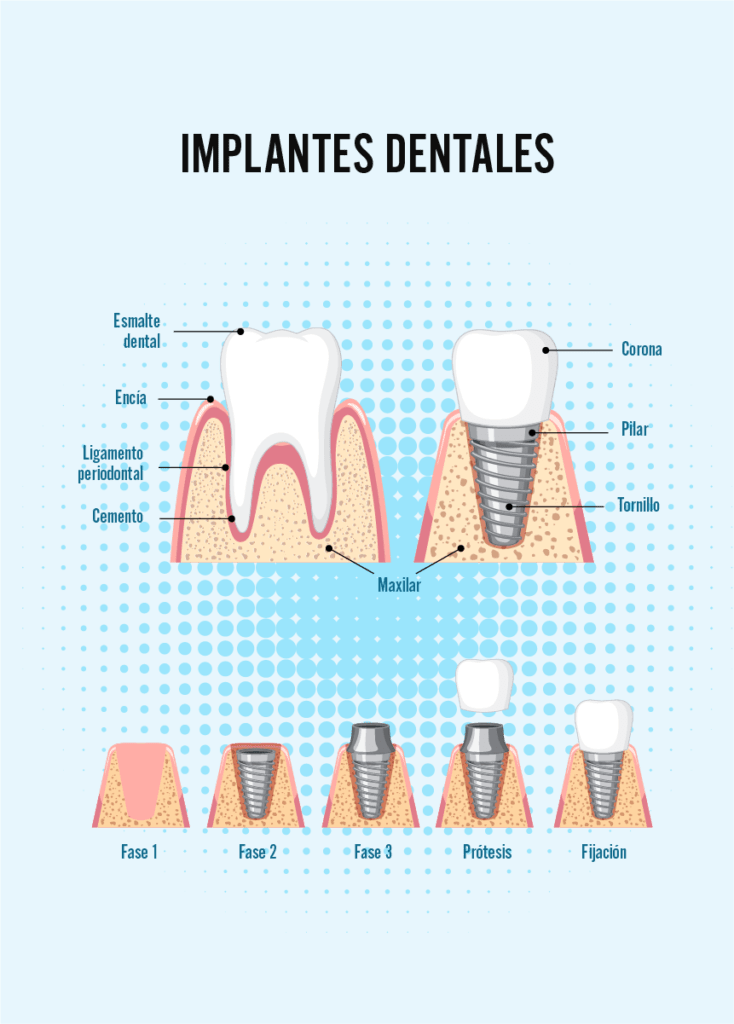 Esquema de un implante dental