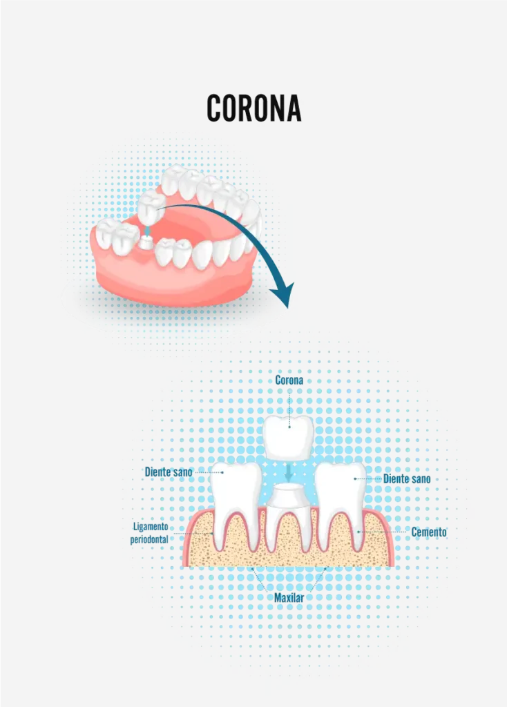 corona dental Servicios dentales de MiraMar Family