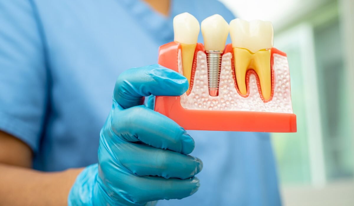 What you need to know about dental implants