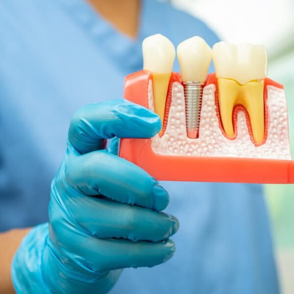 What you need to know about dental implants