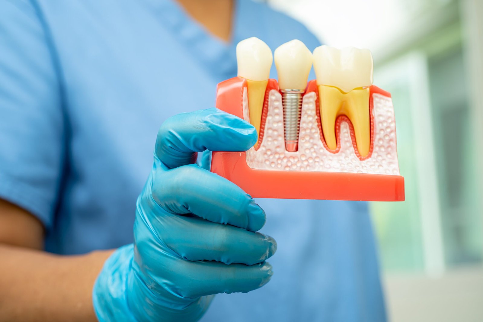 At Miramar Family Dental we explain everything you need to know about dental implants.