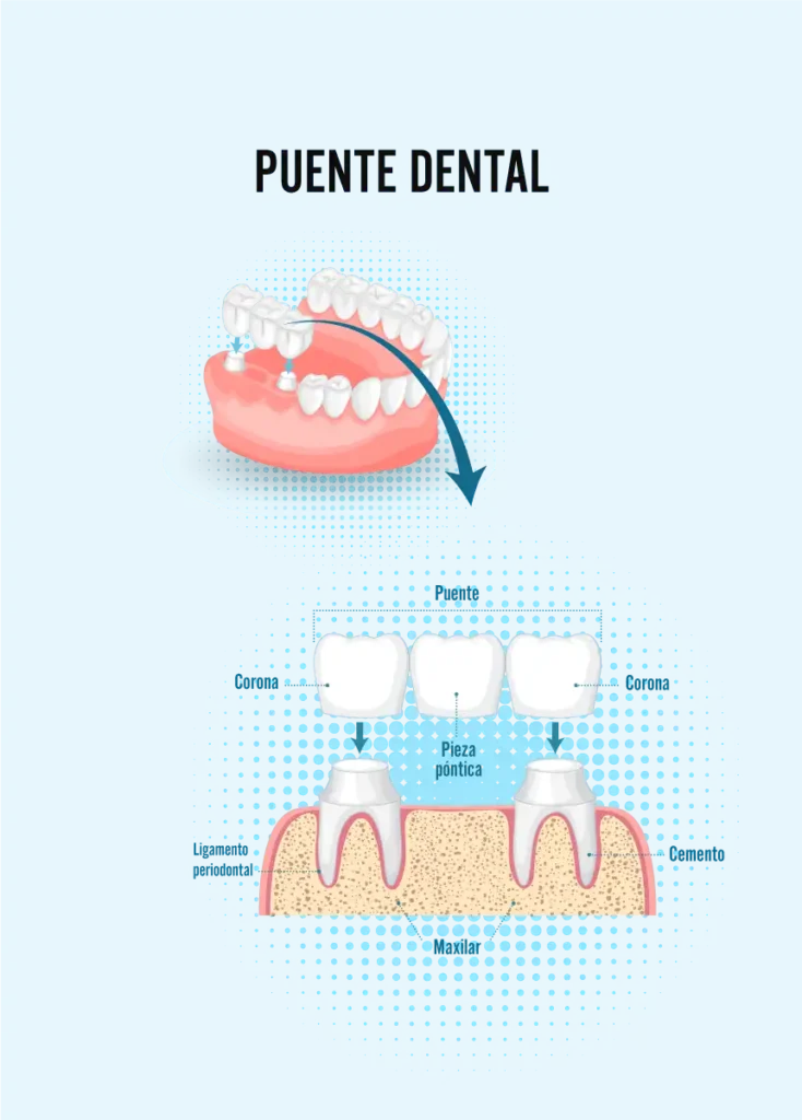 puente dental Servicios dentales de MiraMar Family