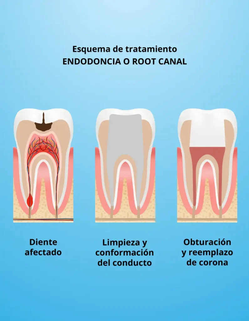 rootcanaltreatment Convertido Servicios dentales de MiraMar Family