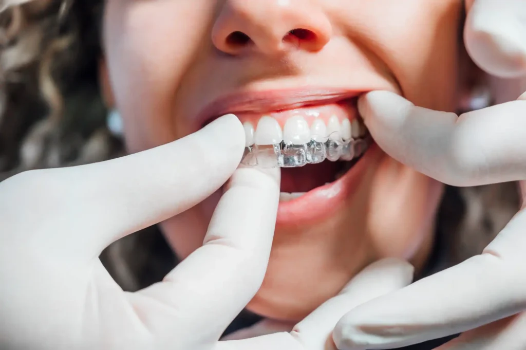 servicios invisalign Miramar Family Dental Services