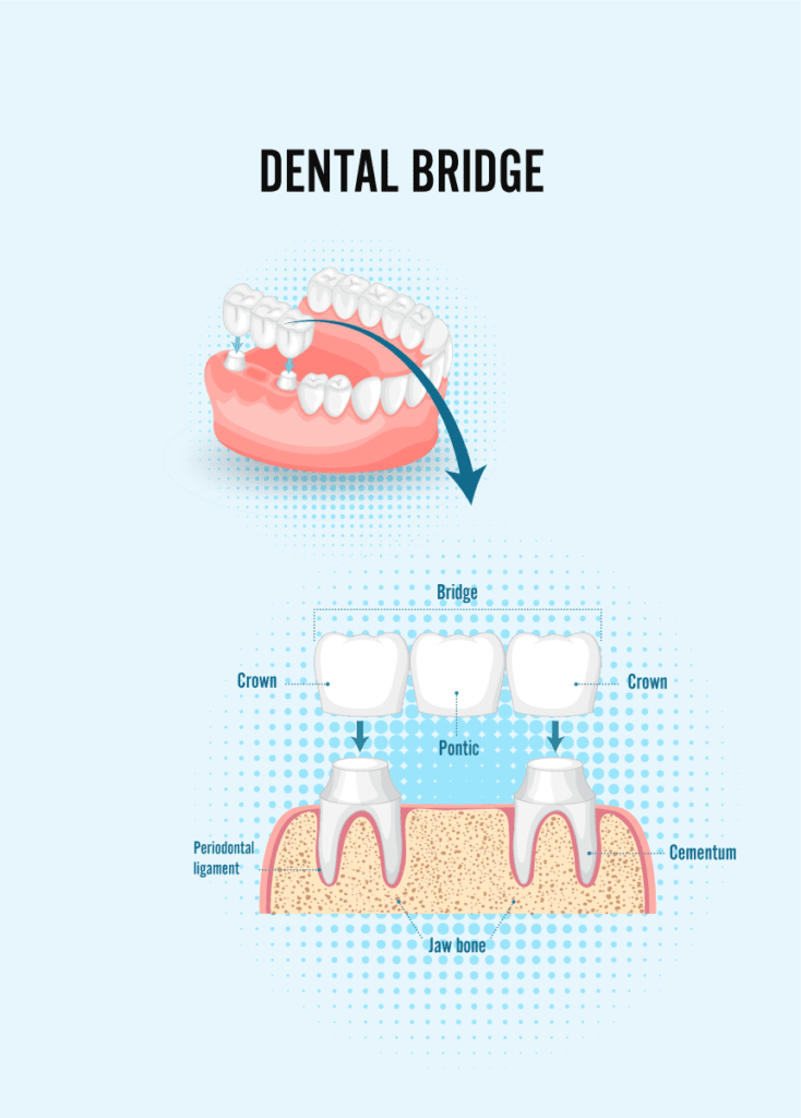 Dental bridge infographic