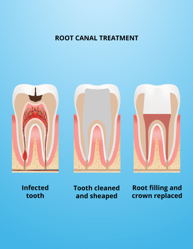 Root canan treatment infographic