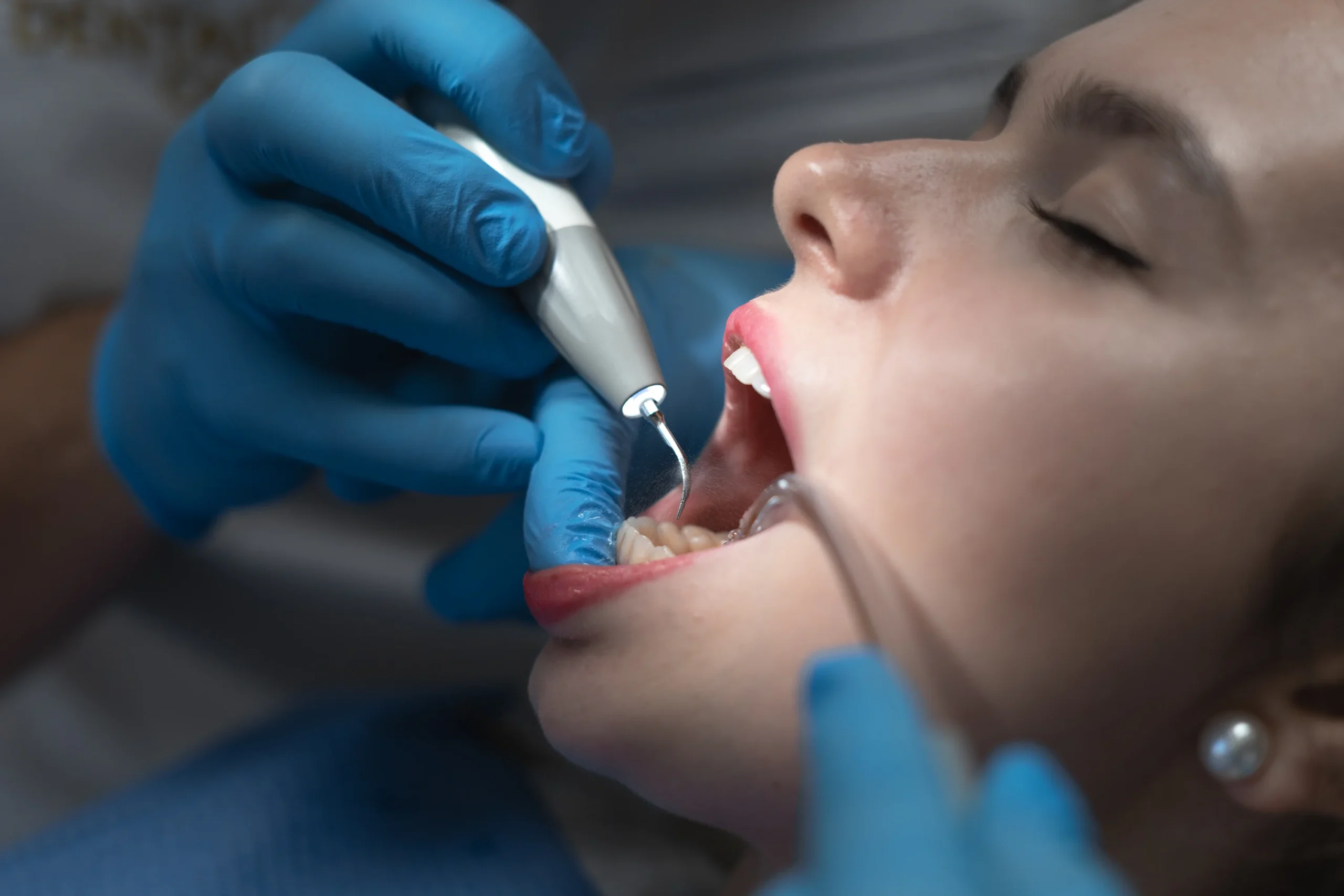 Blog MiraMar Family Dental 1 Higienista realiza una limpieza dental profunda a paciente en el consultorio